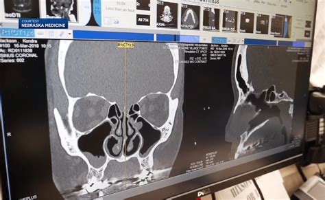 Woman S Constant Runny Nose Turns Out To Be Brain Fluid Leak