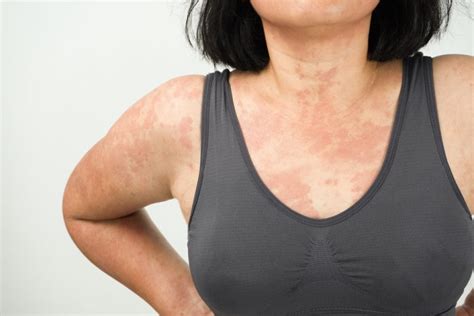 Hives 101 What You Need To Know Buckhead Dermatology