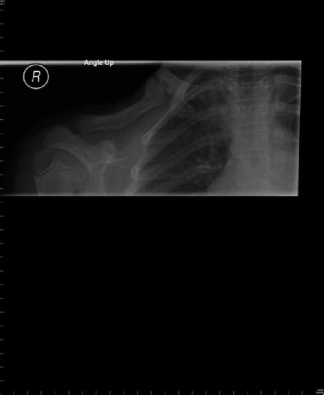 Figure 1 From Clavicle Non Union In Children A Report Of Two Cases And