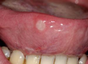 It is said to have a soothing effect and prevents and mitigates the burning sensation seen in mouth ulcers. Cold Sore in Mouth Causes, Pictures, Symptoms, How to Get ...