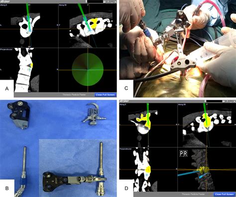 Figure 2 From Posterior Hemivertebra Resection With A Navigated