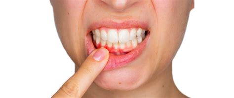 what is stomatitis