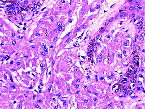 The Tumor Cells Containing Round To Oval Nuclei And Small Eosinophilic