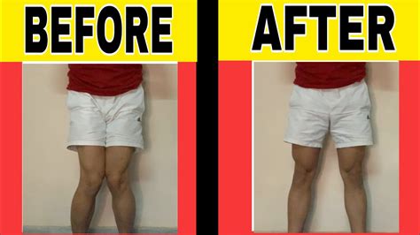Knock Knees Correction Without Surgery How To Fix Problem Of Knock