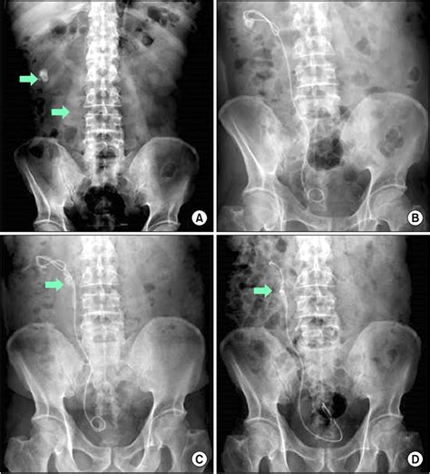 X Ray Images Of The Kidney Ureter And Bladder A Pretreatment