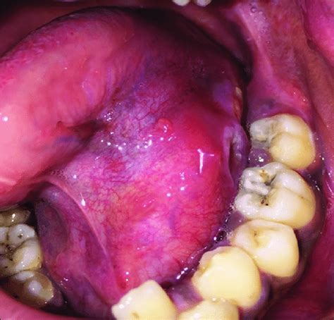 Intraoral Photograph Showing Swelling Left Floor Of Mouth Causing