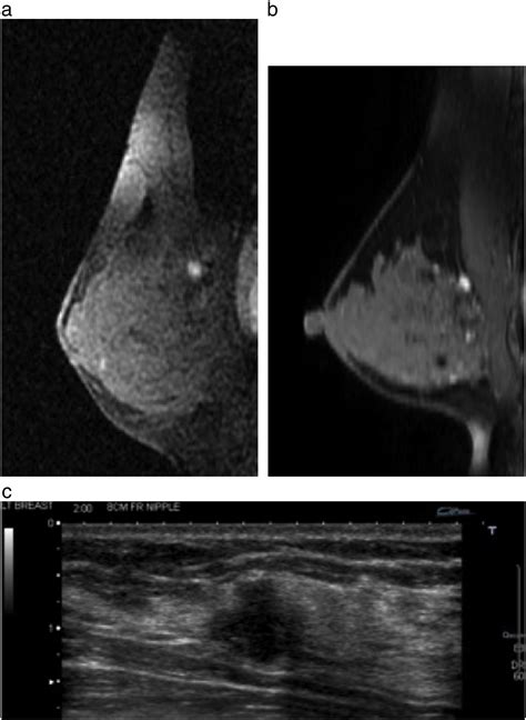 Follow Up Outcomes After Benign Concordant Mri Guided Breast Biopsy