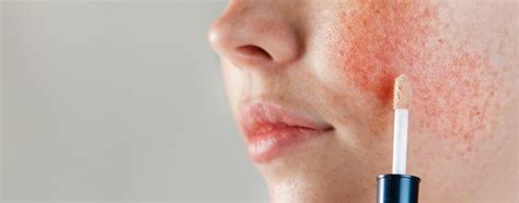 Rosacea is one of the most common skin conditions we treat at skinastute. Rosacea | Focus Arztsuche