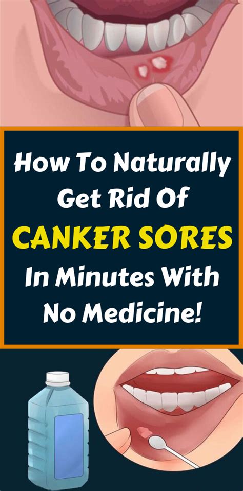 Quick Way To Cure Mouth Ulcer Anna Blog
