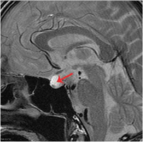 Sagittal T2 Weighted Mri Showing A Rathke Cleft Cyst With Download