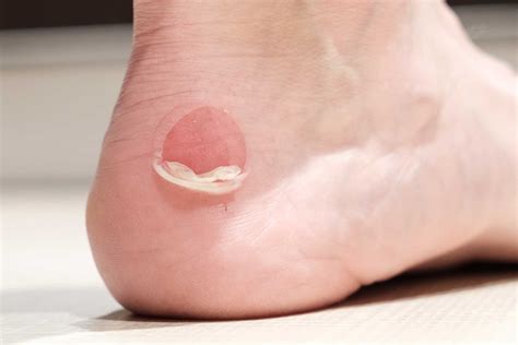 Foot Blisters How Do They Form And Why How To Treat And Prevent