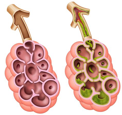Cystic fibrosis liver disease | clinical research workshop. How to treat the symptoms of cystic fibrosis with medical ...