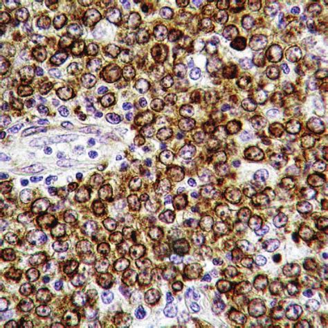Diffuse Large Cell Malignant Lymphoma Positive By Immunohistochemical