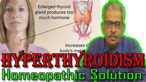 Hyperthyroidism In Hindi Discussion And Treatment In Homeopathy By Dr