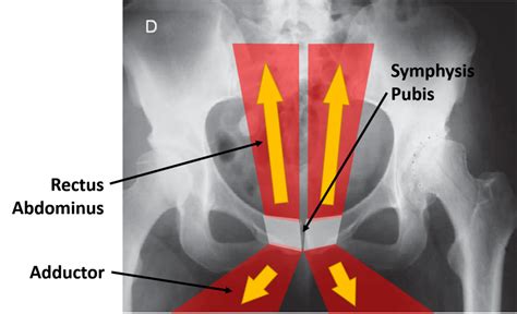 What Is Si Joint Instability Sacroiliac Joint Instability