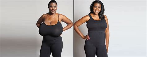 Breast Reduction Surgery Enhance Your Appearance In Dallas Fallen Scoop