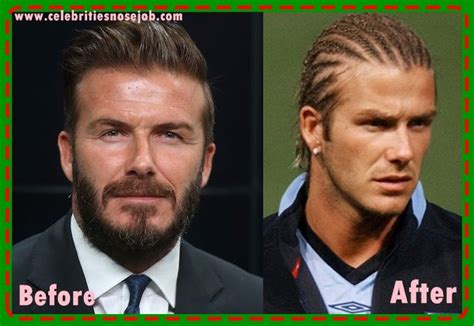 David Beckham Plastic Surgery Nose Job Before And After Surgeons