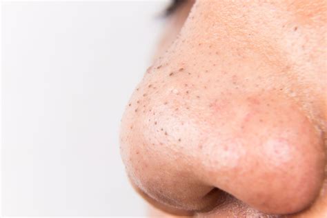 What Are Blackhead Pimples Actually Made Of And Whats Inside Allure
