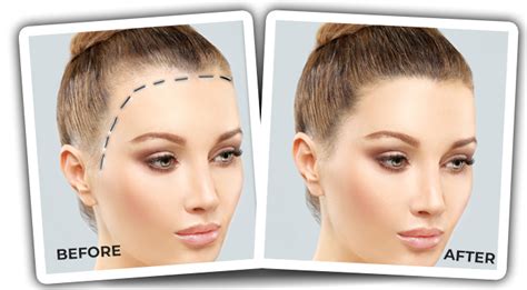 Forehead Reduction With Hair Transplantation In Women Quartz Hair