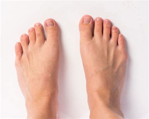 Diabetic Foot Ulcers Prevention And Treatment Sentara Rmh Magazine