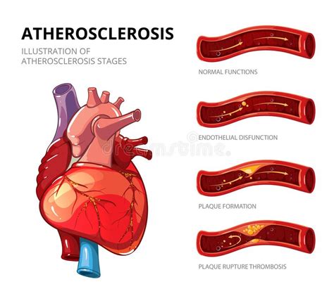 Atherosclerosis Fibrous Plaque Formation Vector Infographic Stock