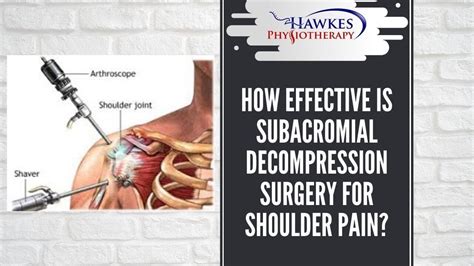 How Effective Is Subacromial Decompression Surgery For Shoulder Pain YouTube