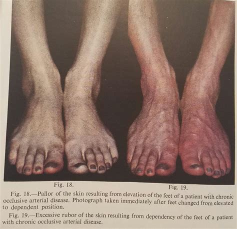 Purple Feet 7 Medical Reasons You Should Look Out For