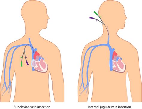 Study Medical Photos Central Venous Line Catheter Related Infections