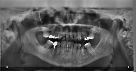 Types Of Dental Radiographs And Their Uses Dentalnotebook
