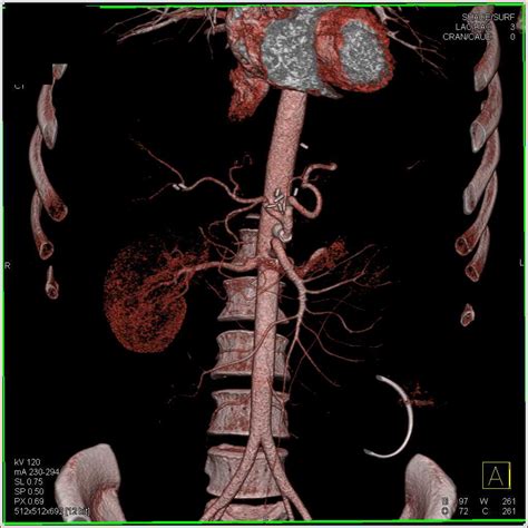 Celiac Stent In Patient With Median Arcuate Ligament Syndrome