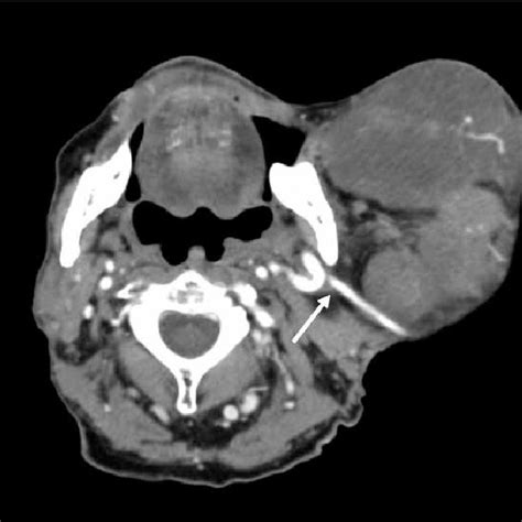 Pdf Giant Pleomorphic Adenoma Of The Parotid Gland An Unusual Case