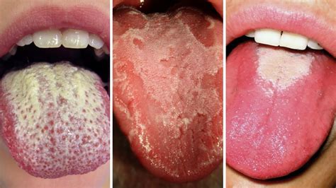 What Your Tongue Has To Say About Your Health Youtube