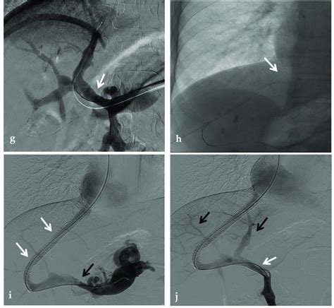 Anteroposterior View Of A Percutaneous Transhepatic And Transsplenic