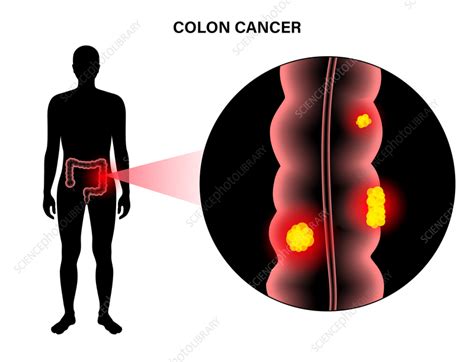 Colorectal Cancer Illustration Stock Image F0351879 Science