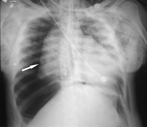 Intraoperative Chest X Ray Shows Bilateral Subcutaneous Air