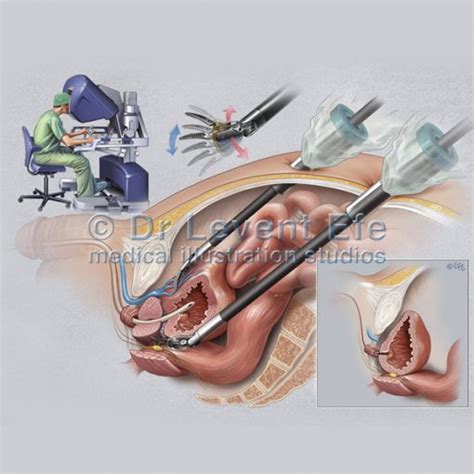 Medical Illustration Robotic Surgery Of The Prostate Surgical Art Surgical Illustrations Dr