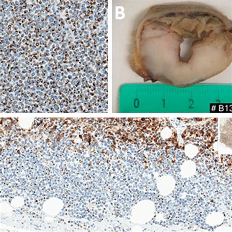 Pdf Multiple Gastrointestinal Metastases Of Merkel Cell Carcinoma