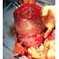 Cureus  Spontaneous Rupture Of The Gravid Uterus In A Postmenopausal