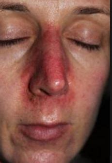 Pictures of gel up with kinky for round face / 8 s. Redness around Nose, Cheeks, Mouth, Causes, Pictures, Get ...