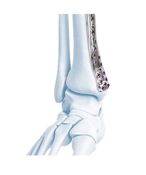 Depuy Synthes Va Lcp Ankle Trauma System