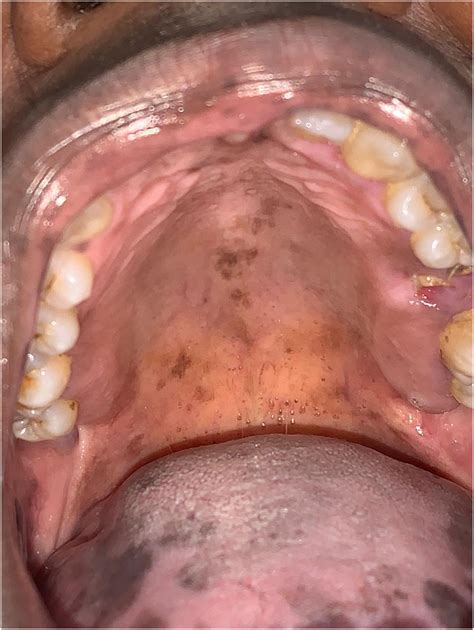 Capecitabine Induced Oral Mucosal Hyperpigmentation Associated With