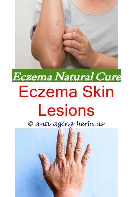 What To Do If I Have Eczema 2022