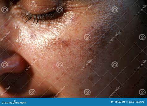 Pigmented Spots On The Face Pigmentation On Cheeks Stock Photo Image