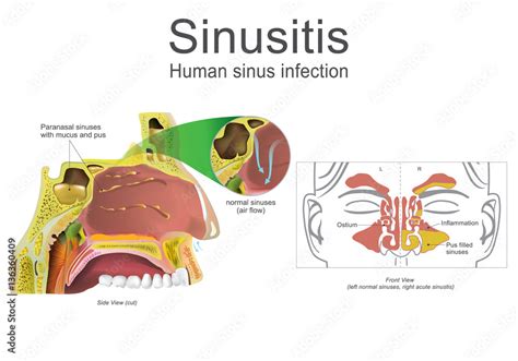 Human Sinusitis Inflammation Illustration Vector Art Stock Vector