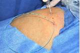 Images of Electrical Catheter Stimulation