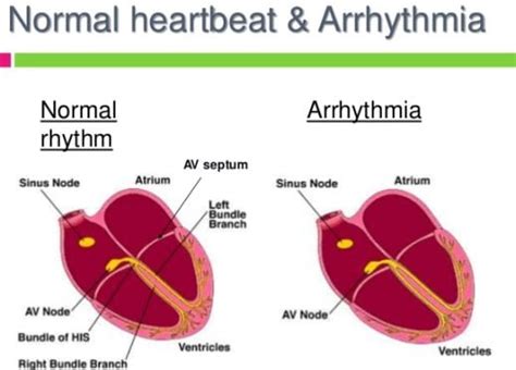 Arrhythmia Home Remedy Treatment Home Remedy And Natural Cures