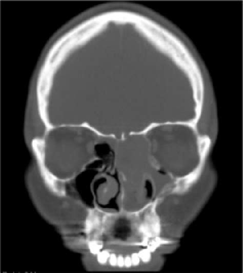 CT Sinus Coronal Section Showing Sinonasal Sarcoma CT Computed
