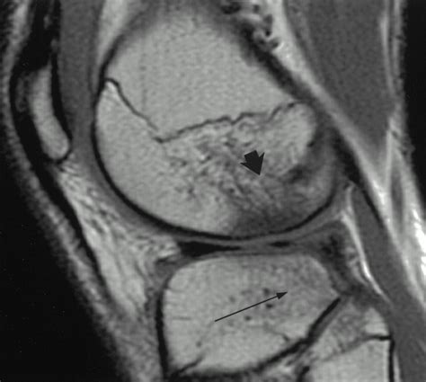 Bone Contusion Patterns Of The Knee At Mr Imaging Footprint Of The