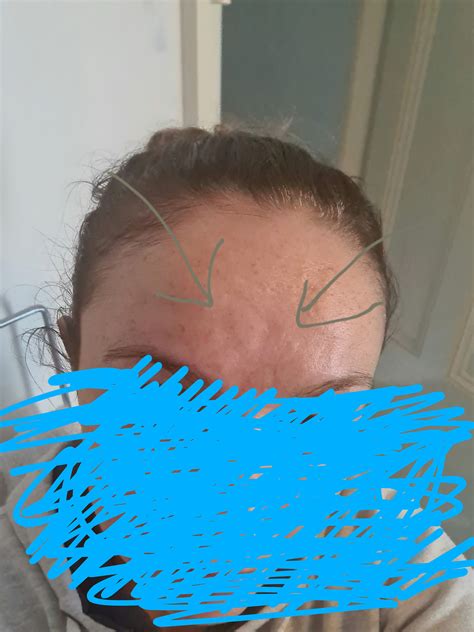 Skin Concern Forehead Indentations Causes R30plusskincare