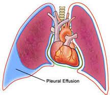 An ineffective breathing pattern is a condition of inadequate ventilation due to an impairment in the mechanism of inspiration and expiration. Ineffective Breathing Pattern related to Pleural Effusion ...